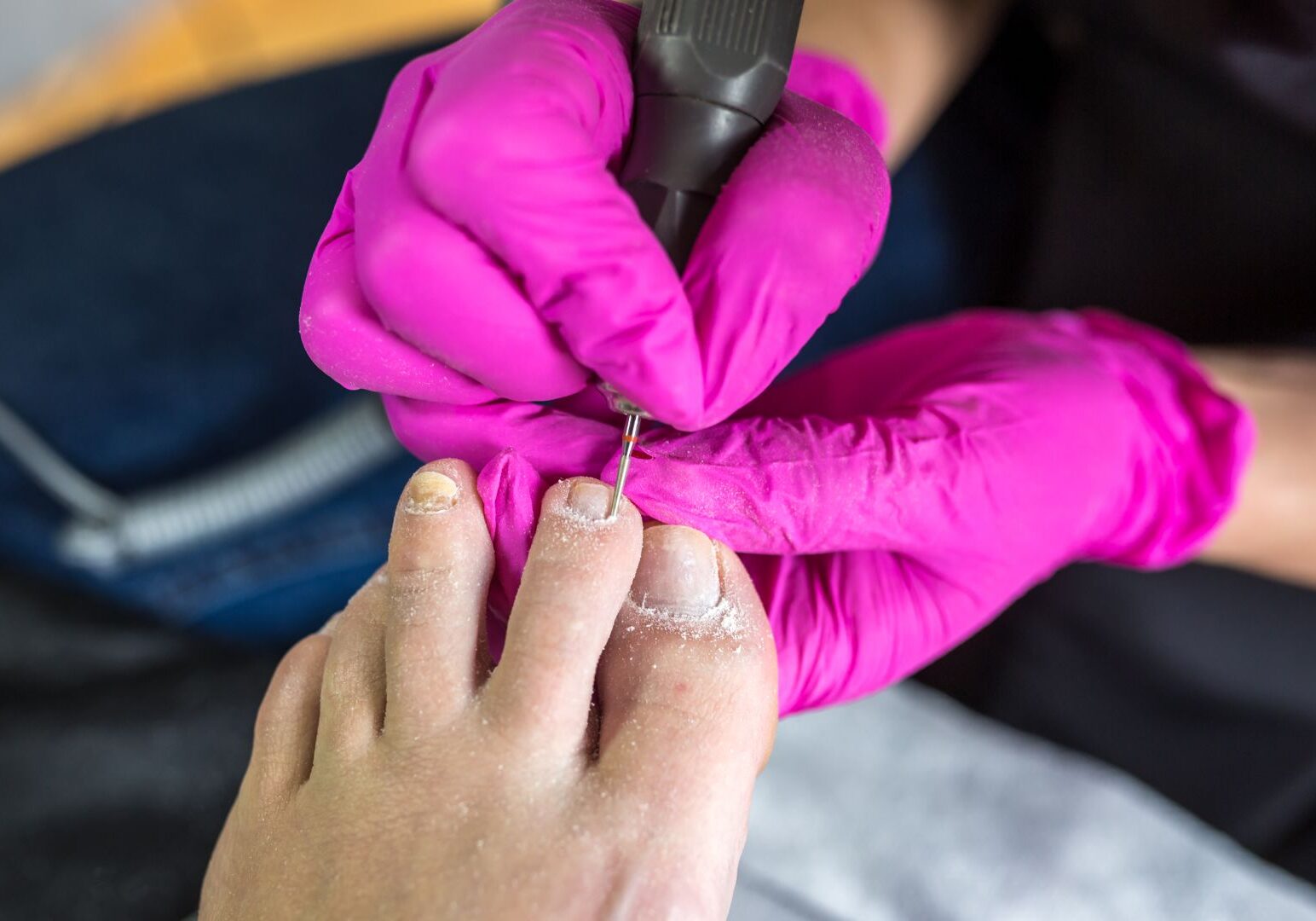 Neglekorrigering med spange