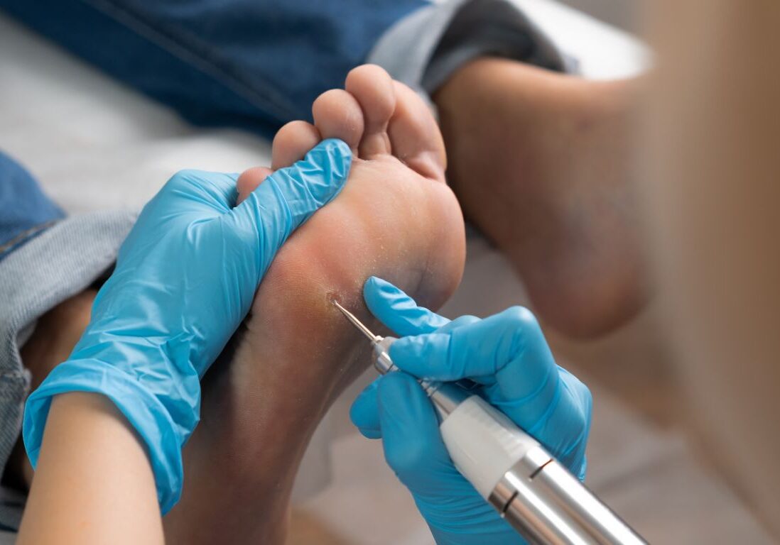 Close up removing a callus on a womans foot by electric drill.